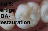 Im Anschluss ist der Zahn durch die SDA-Klebung dicht versiegelt.